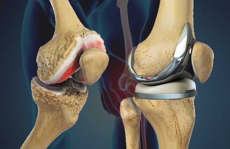 Knee Joint Replacement Doctor in Pimpri Chinchwad