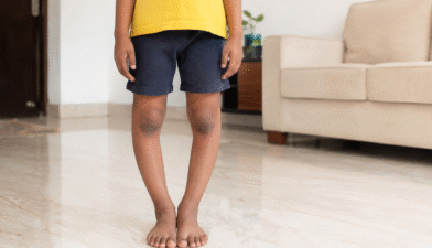 Pediatric doctor examining a young child's bowed legs during checkup