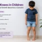 Knock Knees in Children When Normal Growth Becomes a Concern 85x85